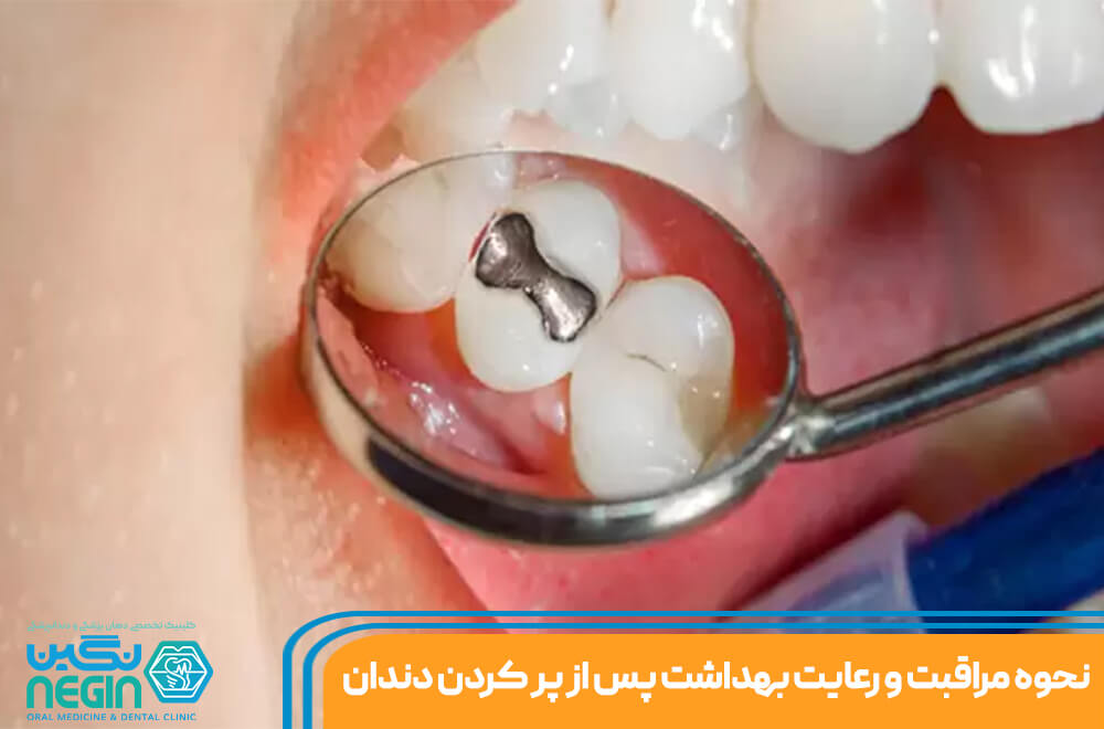 نحوه مراقبت پس از پر کردن دندان در شیراز