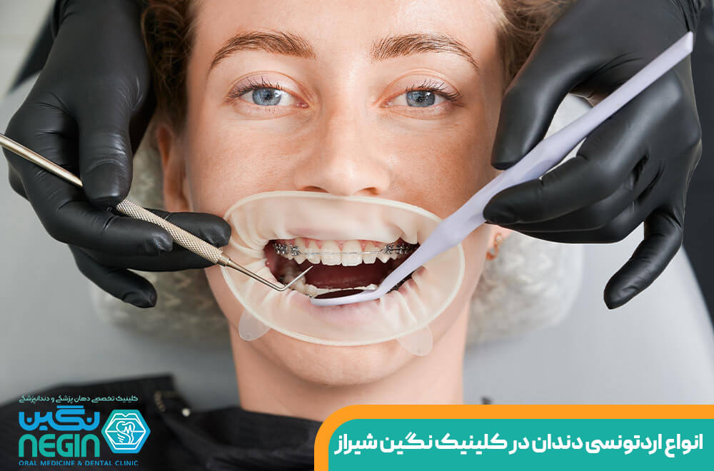 انواع اردتونسی دندان در کلینیک دندانپزشکی نگین شیراز