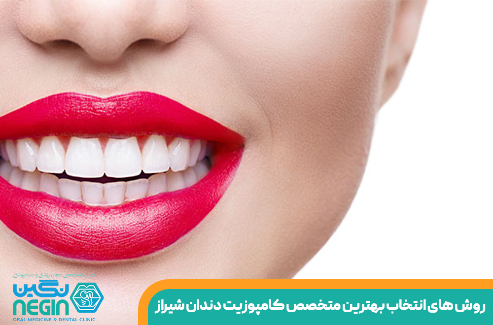 روش های انتخاب بهترین متخصص کامپوزیت دندان در شیراز