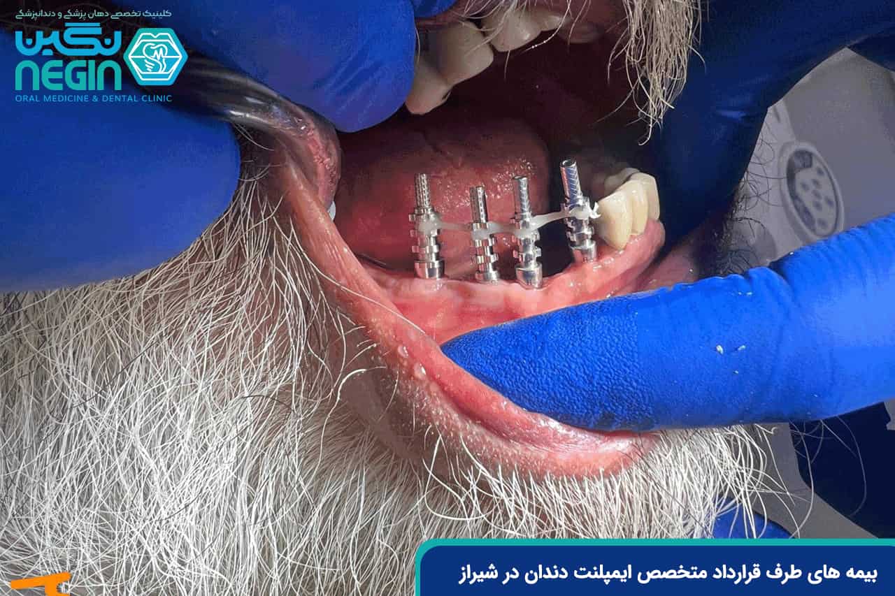 بیمه های طرف قرارداد متخصص ایمپلنت دندان در شیراز