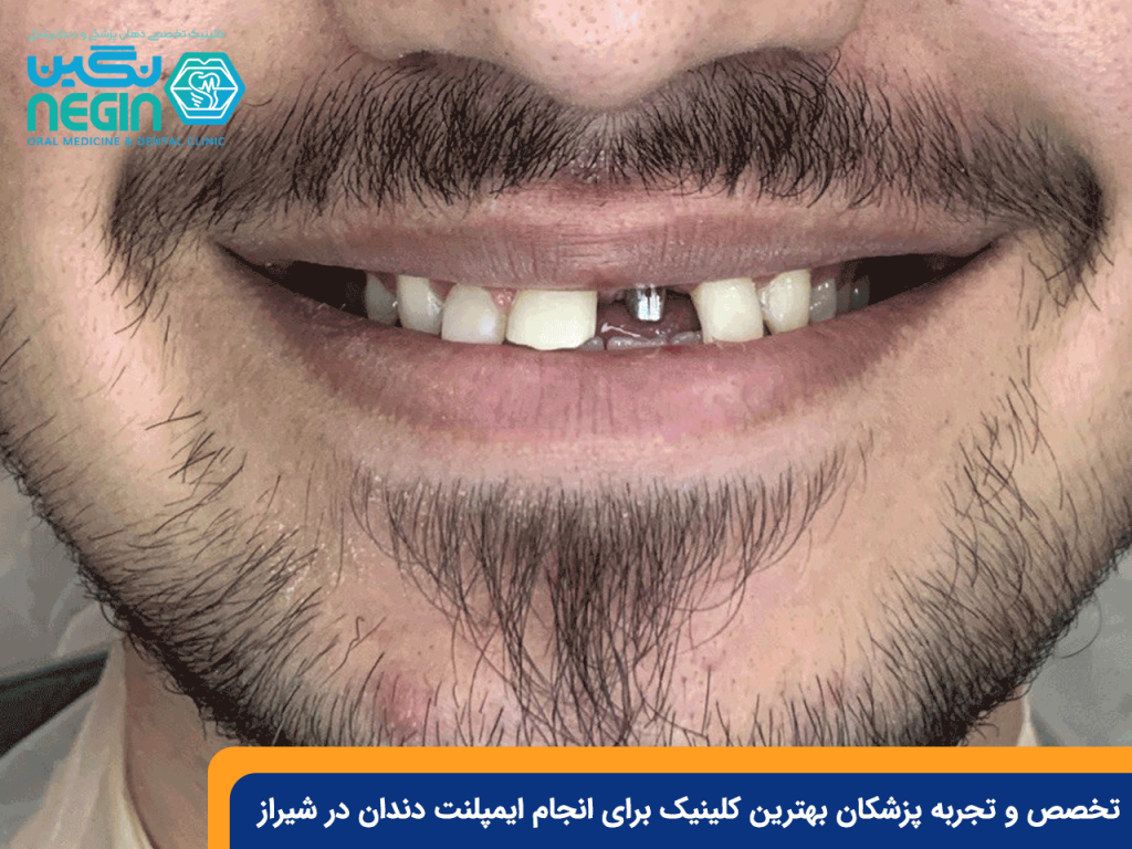 تخصص-و-تجربه-پزشکان-بهترین-کلینیک-برای-انجام-ایمپلنت-دندان-در-شیراز