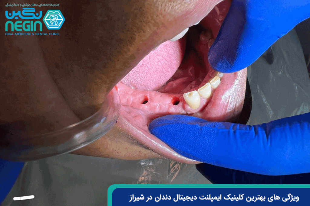 ویژگی های بهترین کلینیک ایمپلنت دیجیتال دندان در شیراز
