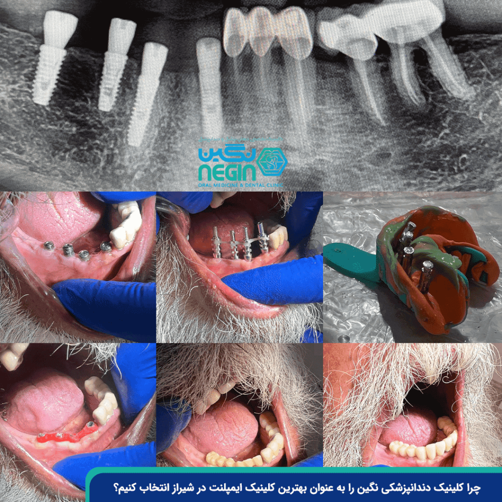 چرا-کلینیک-دندانپزشکی-نگین-را-به-عنوان-بهترین-کلینیک-ایمپلنت-در-شیراز-انتخاب-کنیم؟