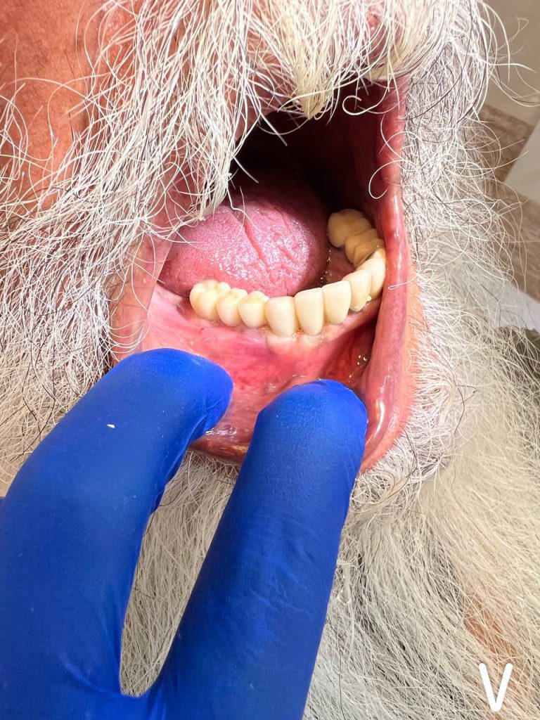 روش های کاشت ایمپلنت دندان در شیراز