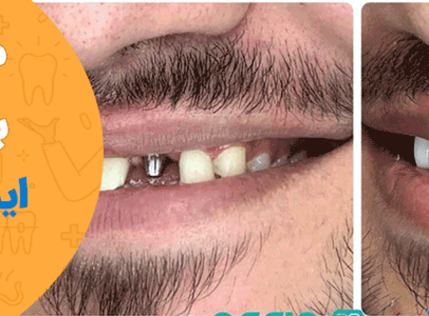 مراقبت های لازم بعد از کاشت ایمپلنت دندان 840x300